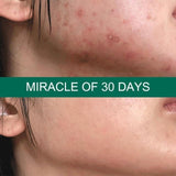 Some By Mi - 30 Days Miracle Tea Tree Clear Spot Oil 10ml